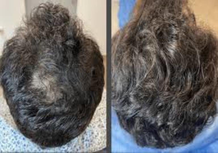 TRATAMIENTO GRAVITY CAPILAR